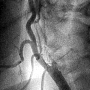 Возможности эндоваскулярной хирургии при атеросклеротическом поражении внутренних сонных артерий