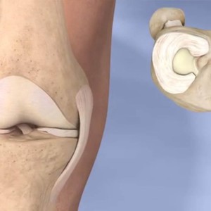 Подробный гайд по мениску