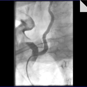Этапное билатеральное стентирование позвоночных артерий у больного с окклюзиями обеих внутренних сонных артерий