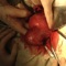 Лапароскопия, иссечение трубного угла матки
