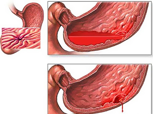 Методы диагностики кровотечения в желудке