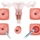 Конизация шейки матки аппаратом высокочастотной радиоволновой хирургии (Сургитрон)