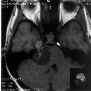 Дифференциальная диагностика между меланотической шваномой гассерова узла и метастатической меланомой основания средней черепной ямки