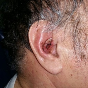 Закрытие язвенного дефекта кожи ушной раковины PRF мемебраной