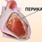 Удаление кисты перикарда видеоторакоскопическое