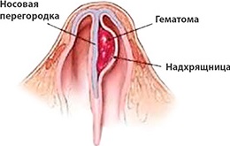 Hominick Hematoma