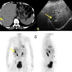 Позитронно-эмиссионная томография в дифференциальной диагностике очаговых образований печени