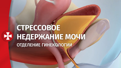 Гинекология. Стрессовое недержание мочи
