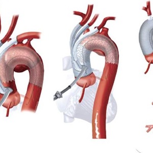 Гибридные эндоваскулярные вмешательства при аневризмах восходящей аорты и дуги аорты