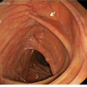 Как правильно подготовиться к колоноскопии