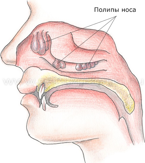 Полип Носа Симптомы Фото