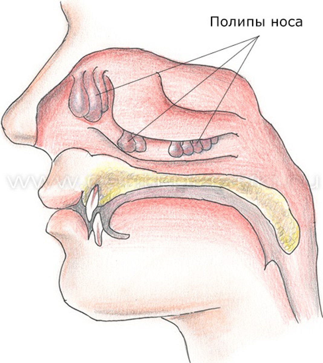 Полипы в носу - симптомы и лечение