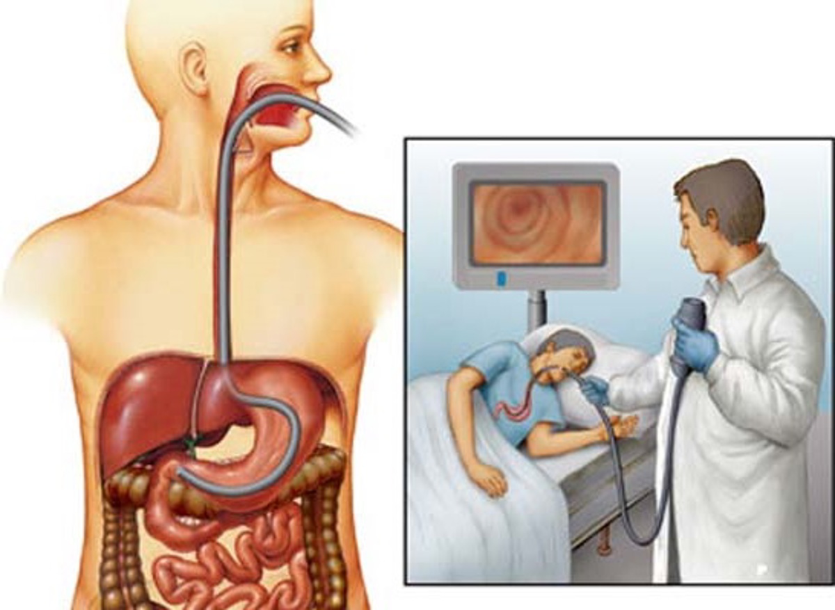 Исследования пищевода и желудка. Язва желудка ФГДС эндоскопия. Двенадцатиперстная кишка ФГДС. Эндоскопическое исследование пищевода, желудка. Язвенная болезнь двенадцатиперстной кишки ФГДС.