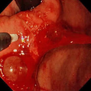 Эндоскопический гемостаз  при острых гастродуоденальных язвенных кровотечениях