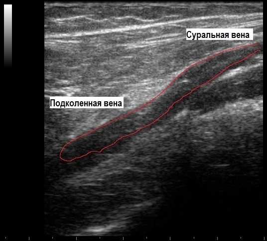 Тромбоз суральной вены. Тромбоз подключичной вены УЗИ допплер. Тромбоз суральной вены на УЗИ. Тромбоз вен голени на УЗИ.