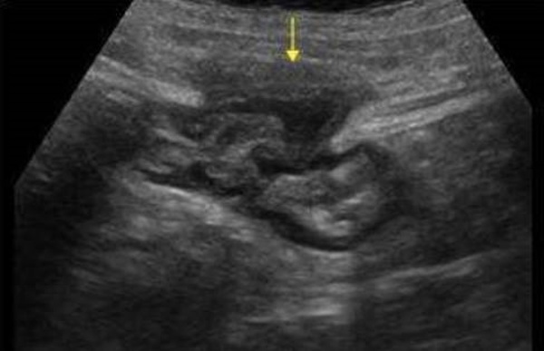 sirenomelia ultrasound