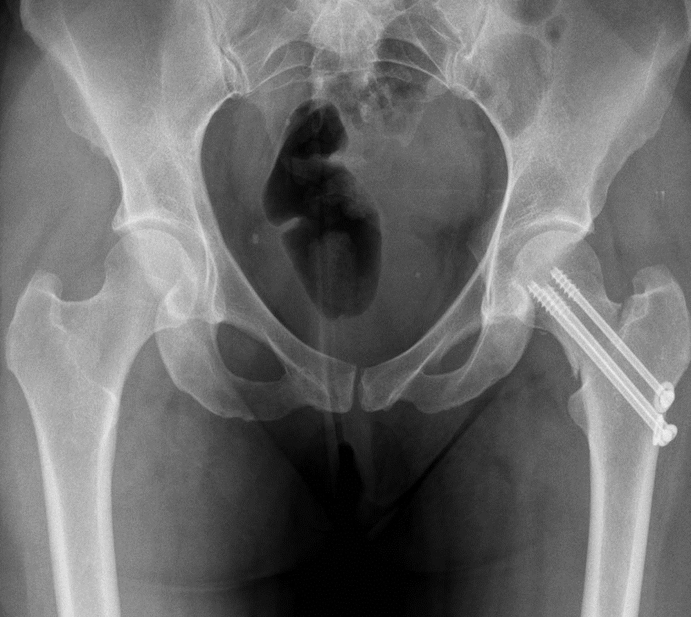 Врач шейка бедра. Субкапитальный перелом шейки бедра рентген. Субкапитальный перелом шейки бедренной кости. Перелом шейки бедра рентгенограмма. Несросшийся перелом шейки бедра.