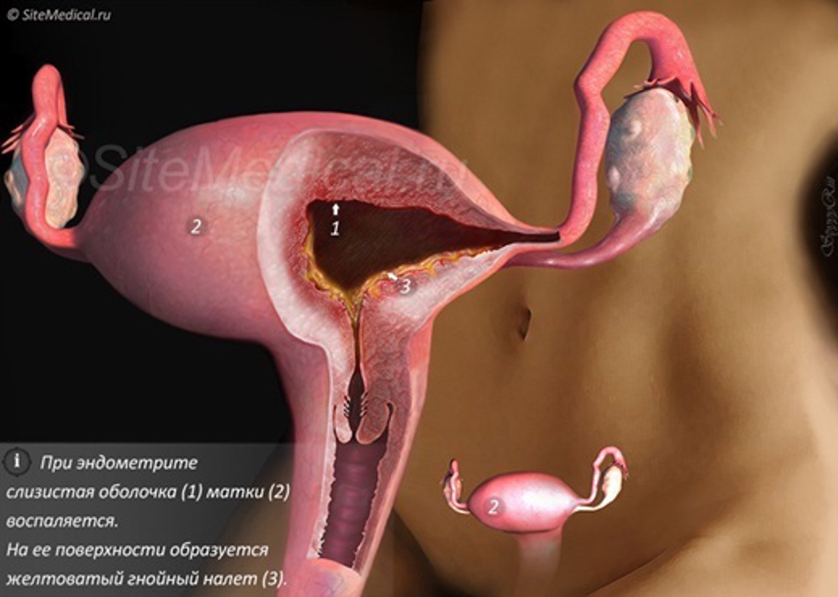 Внутреннее воспаление матки. Хронический эндометриоз. Эндометриоз маточных труб.