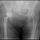 Эндопротезирование тазобедренного сустава при переломе шейки бедренной кости протезом с двойной мобильностью