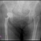 Эндопротезирование тазобедренного сустава при переломе шейки бедренной кости протезом с двойной мобильностью