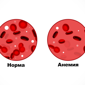 Клинические особенности холодовой агглютинации