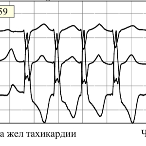 Катетерная абляция или медикаментозная антиаритмическая терапия для лечения желудочковой тахикардии