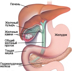 Калькулезный холецистит что это такое