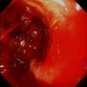 Эндоскопическая диагностика при острых гастродуоденальных язвенных кровотечениях