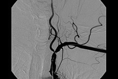Ангиопластика и стентирование подключичных артерий 