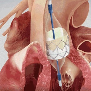 Проведение мастер-класса по эндоваскулярной имплантации аортального клапана