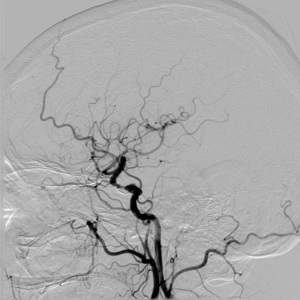 Клинический случай стентирования супраклиноидного отдела левой внутренней сонной артерии у пациента с повторными острыми нарушениями мозгового кровообращения