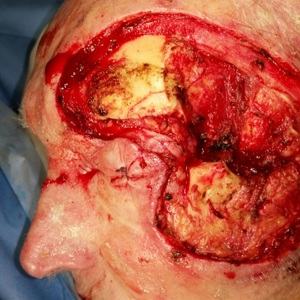 Базальноклеточный рак кожи левой бровной области