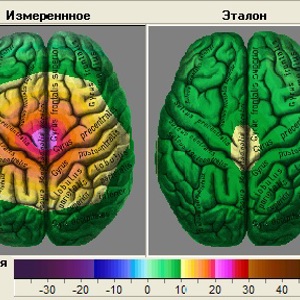Инструментальная диагностика нейрометаболизма при додементных когнитивных расстройствах у пациентов молодого и среднего возраста