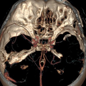 Клипирование аневризмы средней мозговой артерии в стадии разрыва