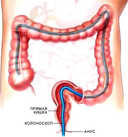 Меню перед колоноскопией кишечника меню на 3 дня с мовипрепом