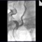 Ангиопластика и стентирование позвоночных артерий