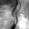 Ангиопластика и стентирование сонных артерий