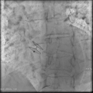 Открытое овальное окно – что это и как лечить?