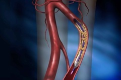 Ангиопластика и стентирование артерий голени