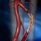 Ангиопластика и стентирование артерий голени