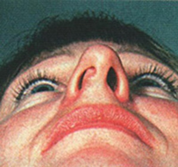 Симптомы отека слизистой носа