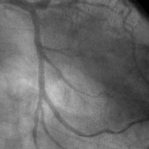 Наш опыт бифуркационного стентирования коронарных артерий у больных ишемической болезнью сердца с помощью стентов с антипролиферативным покрытием