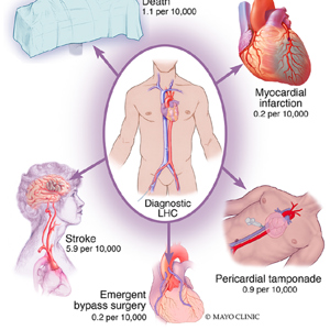 Прогнозирование развития острого нарушения мозгового кровообращения у пациентов с ишемической болезнью сердца