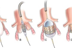 Транскатетерная имплантация аортального клапана (TAVI)