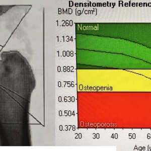 Атеросклероз и остеопороз. Общие мишени для влияния сердечно-сосудистых и антиостеопорозных препаратов. Влияние сердечно-сосудистых препаратов на прочность костной ткани.