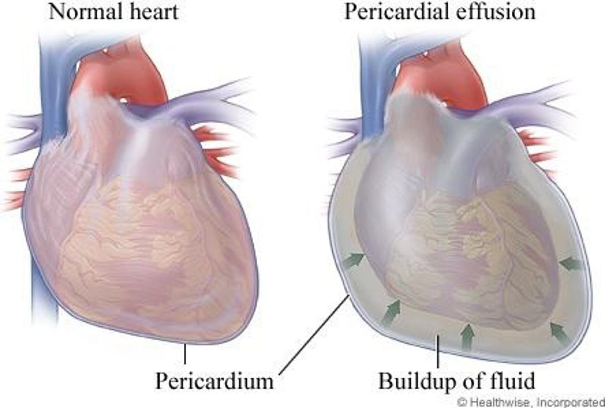 Скопление воздуха и крови в перикарде. Гидроперикард тампонада сердца. Перикардит гидроперикардит. Перикардит и тампонада сердца. Перикардит расхождение листков перикарда.
