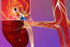 Денервация почечных артерий