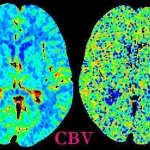 Перфузионная  компьютерная томография головного мозга в диагностике острых и хронических нарушений мозгового кровообращения