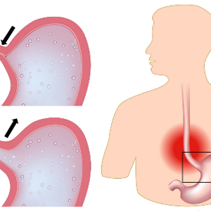 Взаимосвязь между обструктивным апноэ сна (СОАС) и гастроэзофагеальной рефлюксной болезнью (ГЭРБ) в стационарных условиях: Общенациональное исследование