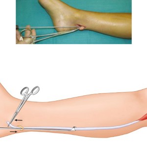 Артроскопическая реконструкция передней крестообразной связки из сухожилия длинной малоберцовый мышцы
